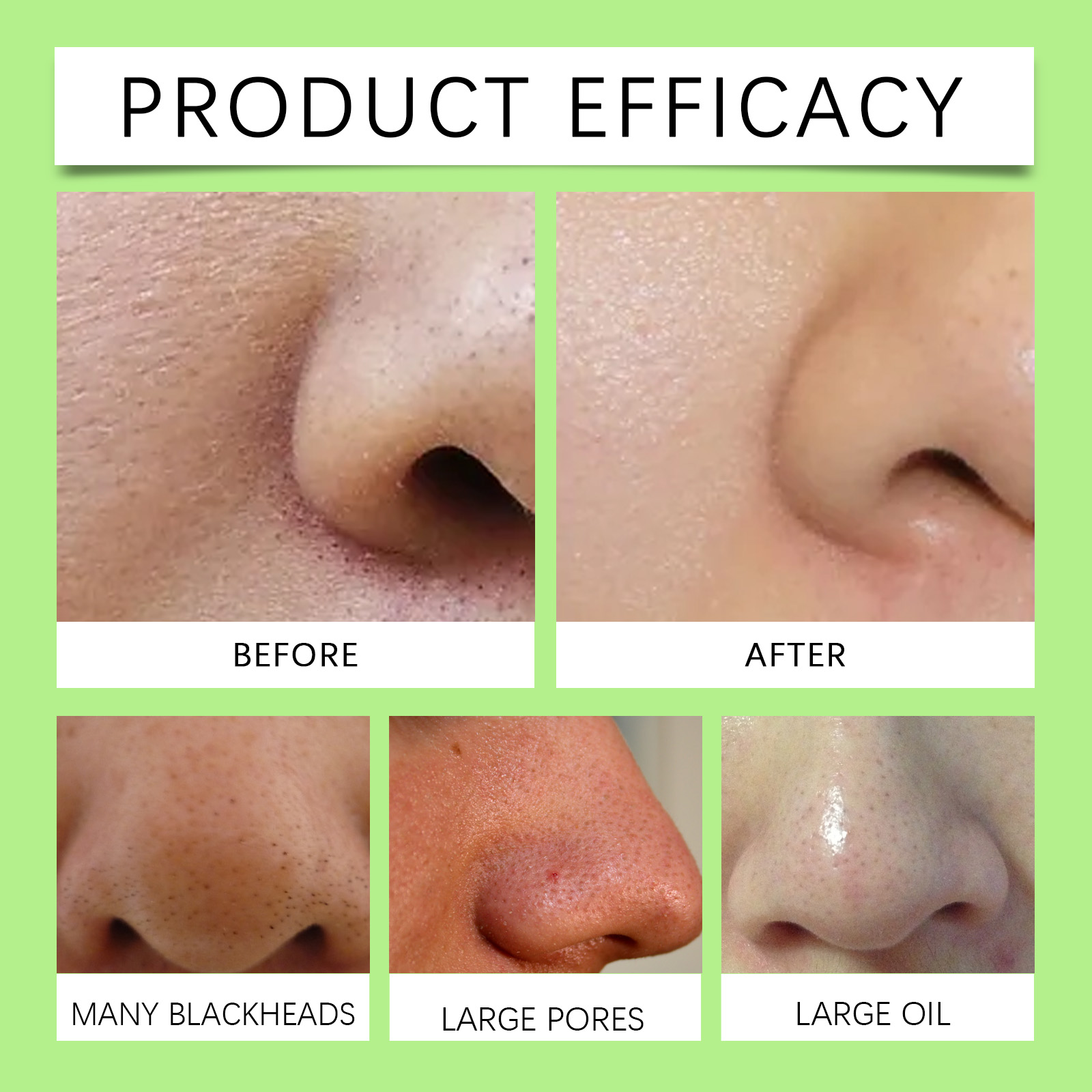 แผ่นแปะจมูกถ่านไม้ไผ่สำหรับสิว - Cleanser Face บทวิจารณ์และราคา